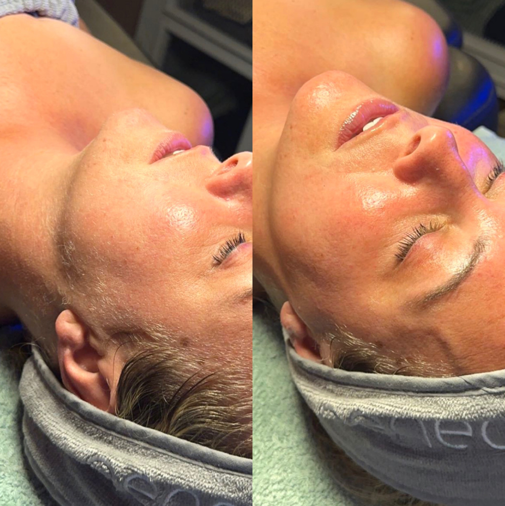 Dermaplane Facial