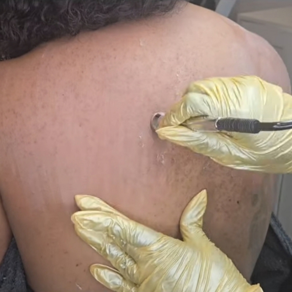 Back Facial With Microdermabrasion at Basic and Beyond Brows in Lakewood, CA