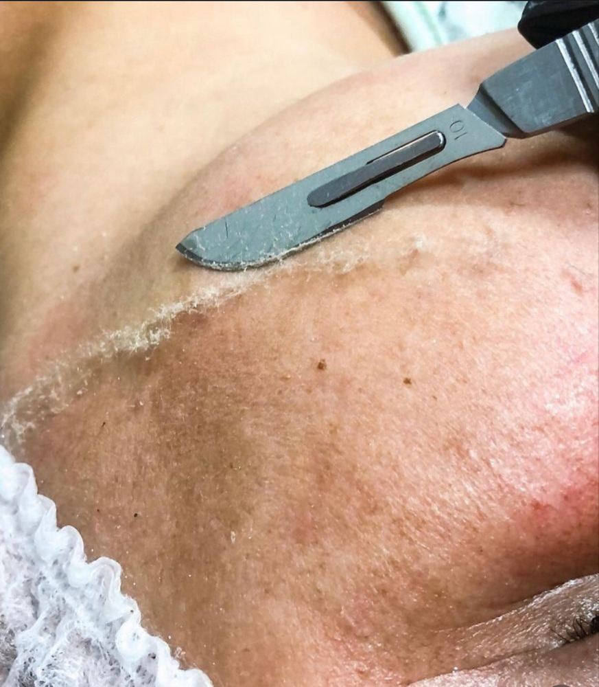 Dermaplaning