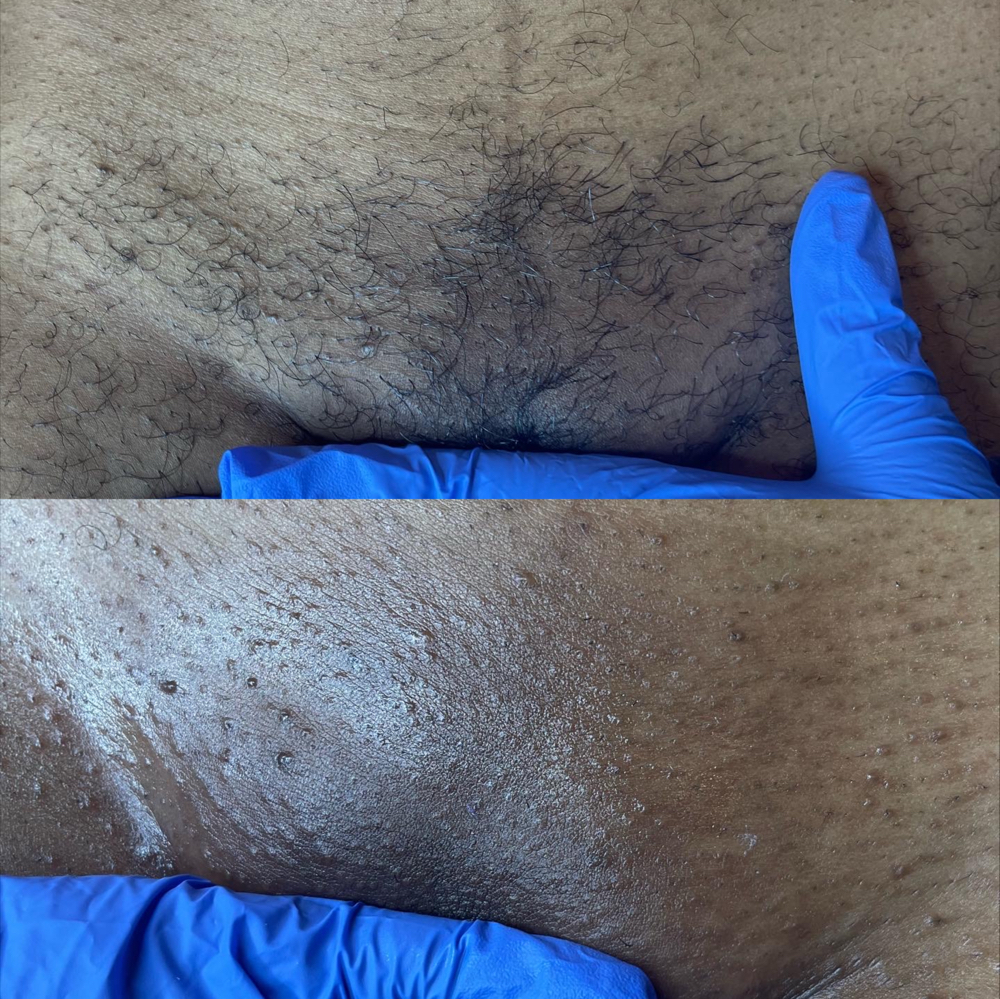 3-4 WEEKS BRAZILIAN WAX(RETURNING) at Belleza Skin in Tinley Park, IL