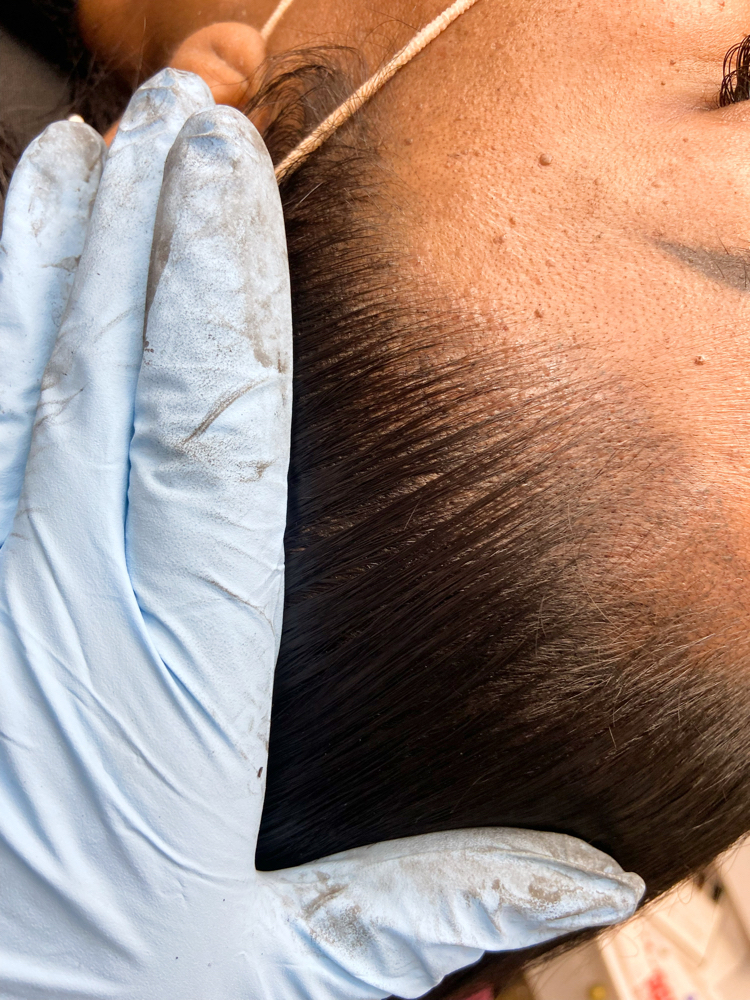 Scalp Micropigmentation