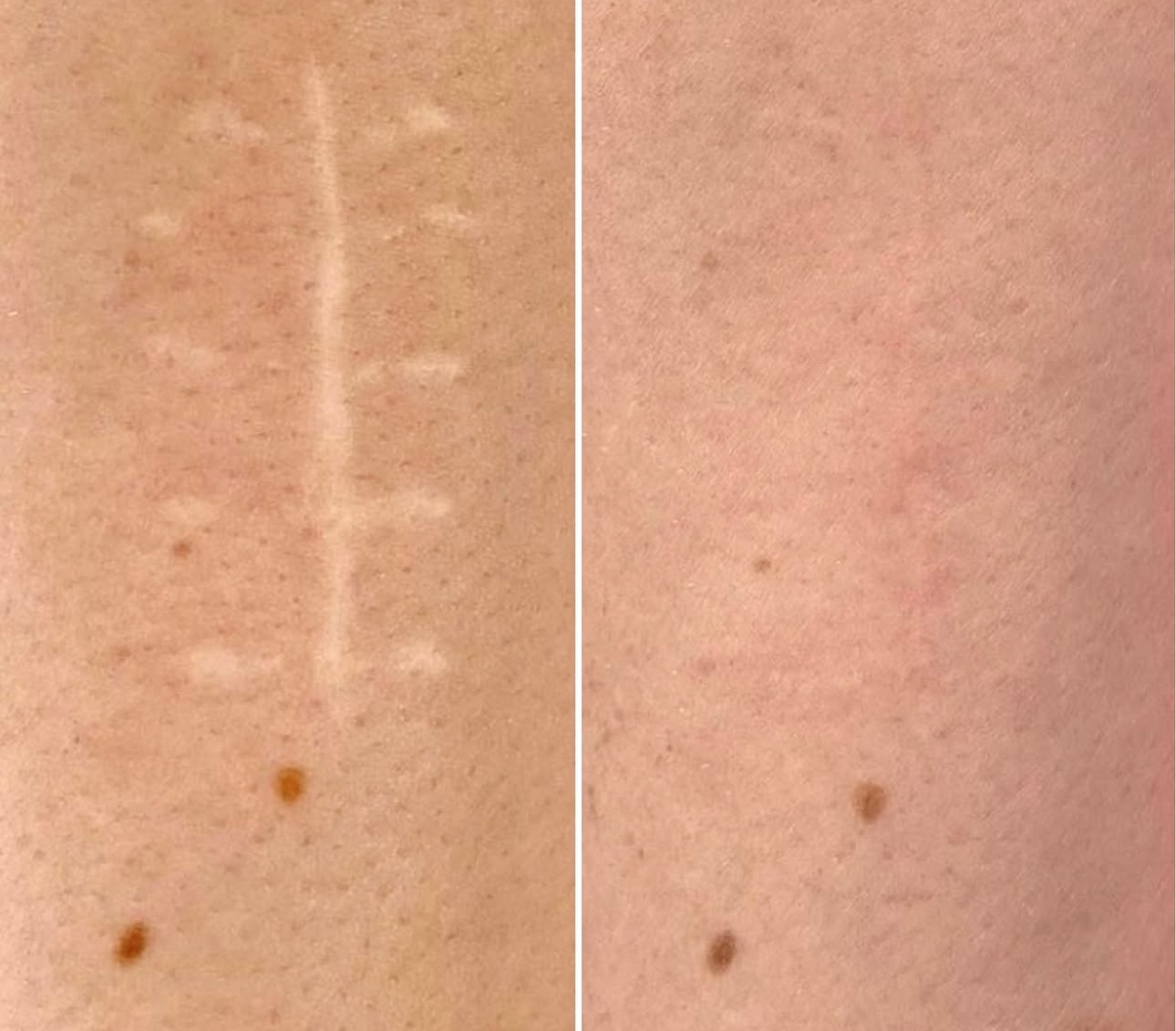 Stretch Mark Camouflage 12”