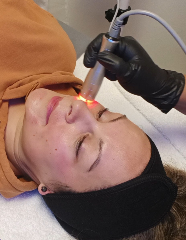 RADIO-FREQUENCY SKIN TIGHTENING