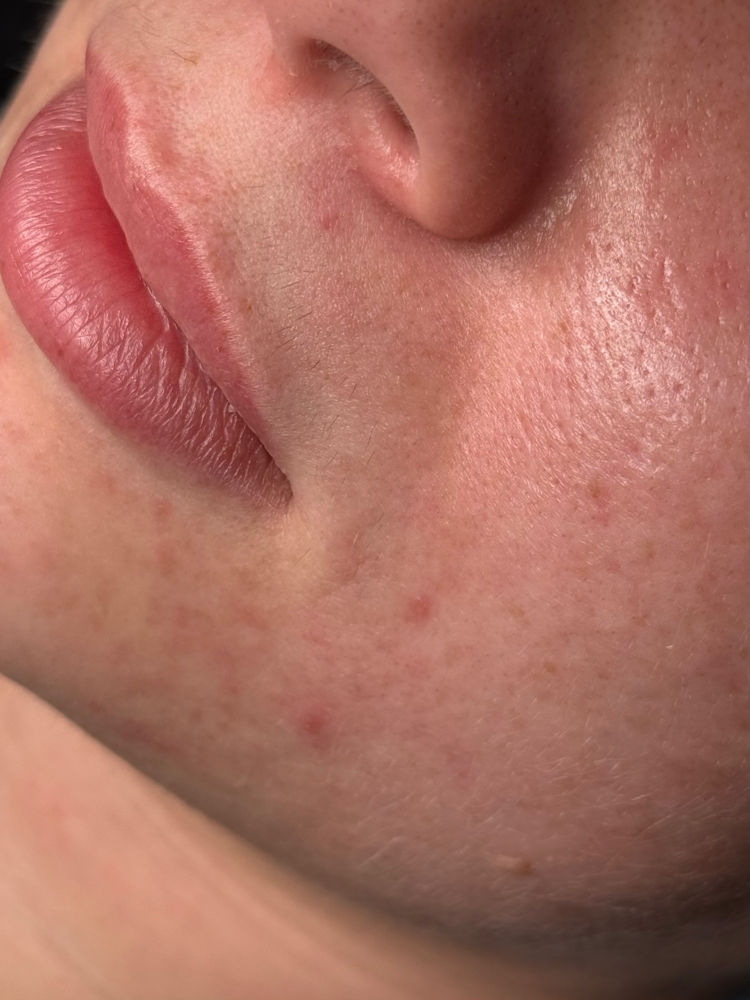 the acne bootcamp treatment at Butler Skin in Sheridan, WY