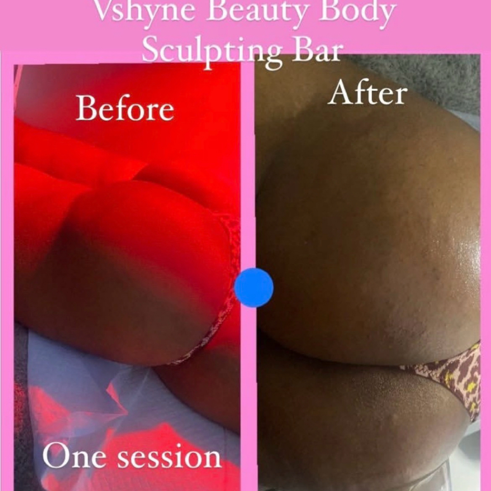 Nine Invasive But Enhancement at Vshyne Beauty Body Sculpting bar LLC in New Orleans La, LA