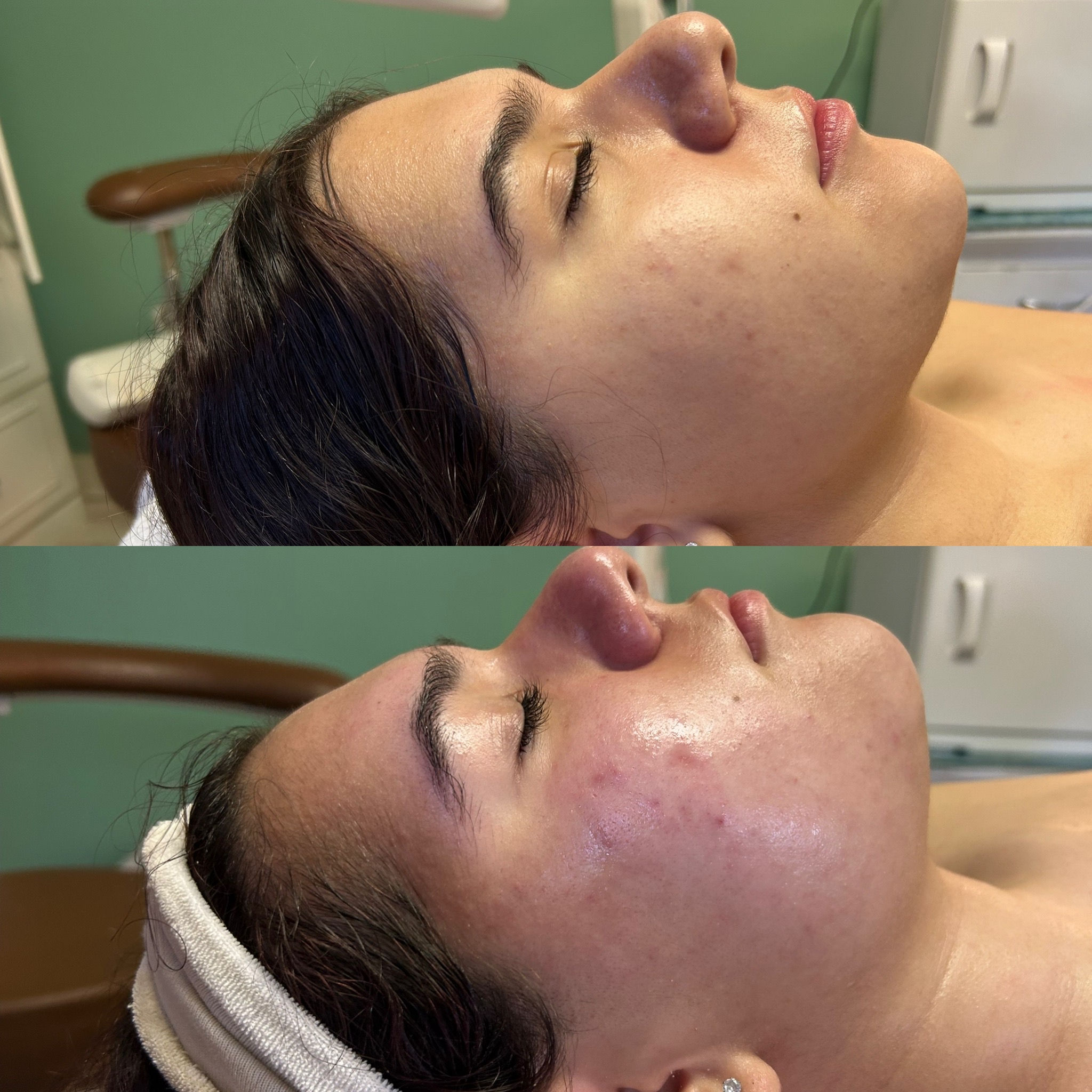 Clinical Facial with Peel