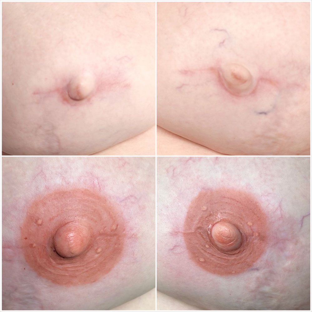 2-Breast Areola Restoration at Cosmetic Studio 54 in Los Angeles, CA