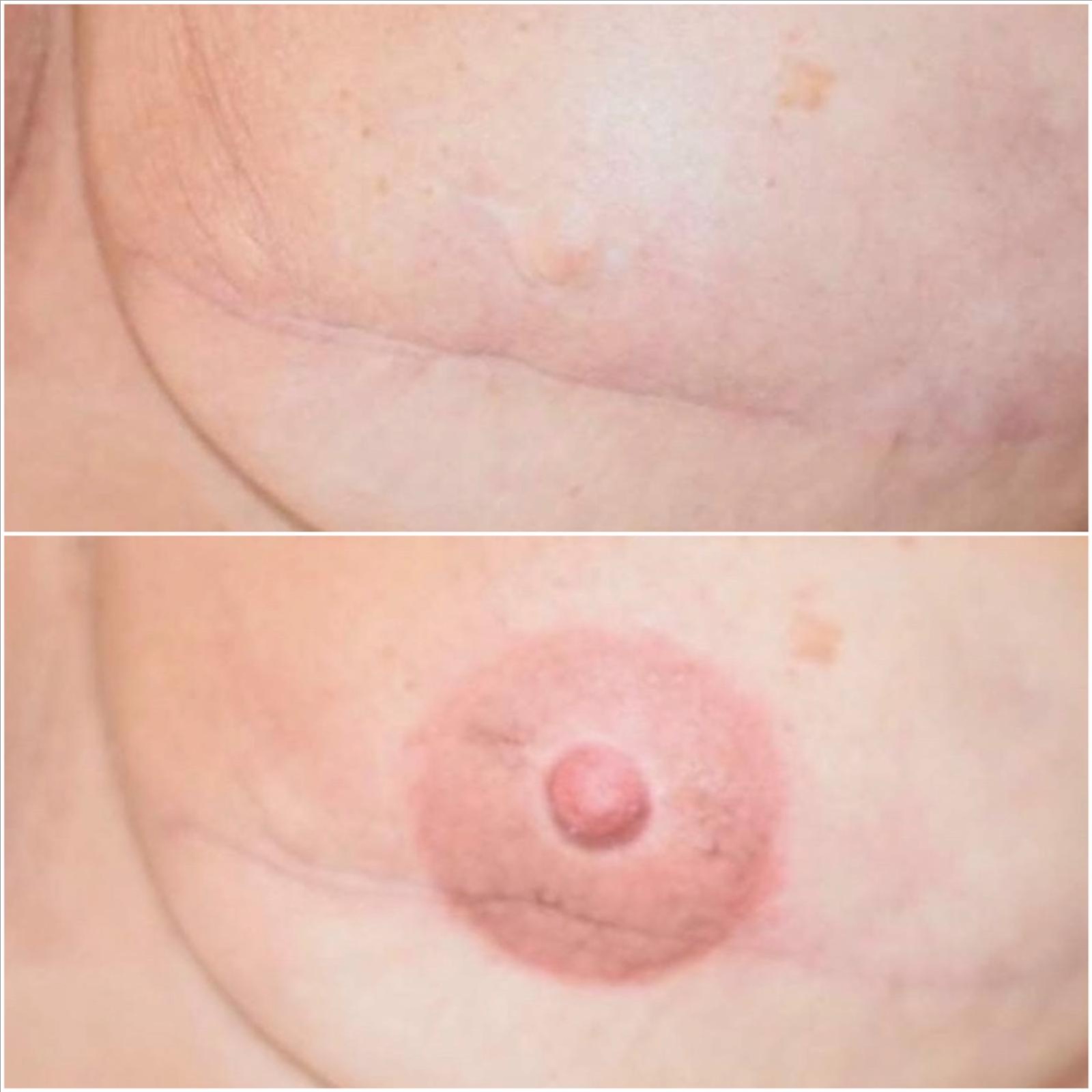 2-Breast Areola Restoration at Cosmetic Studio 54 in Los Angeles, CA