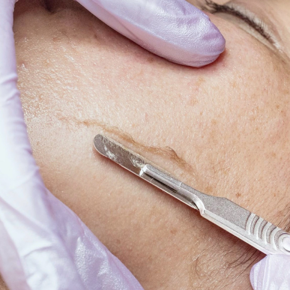 Dermaplane Radiance Facial at Del Sol Skin in East Islip, NY