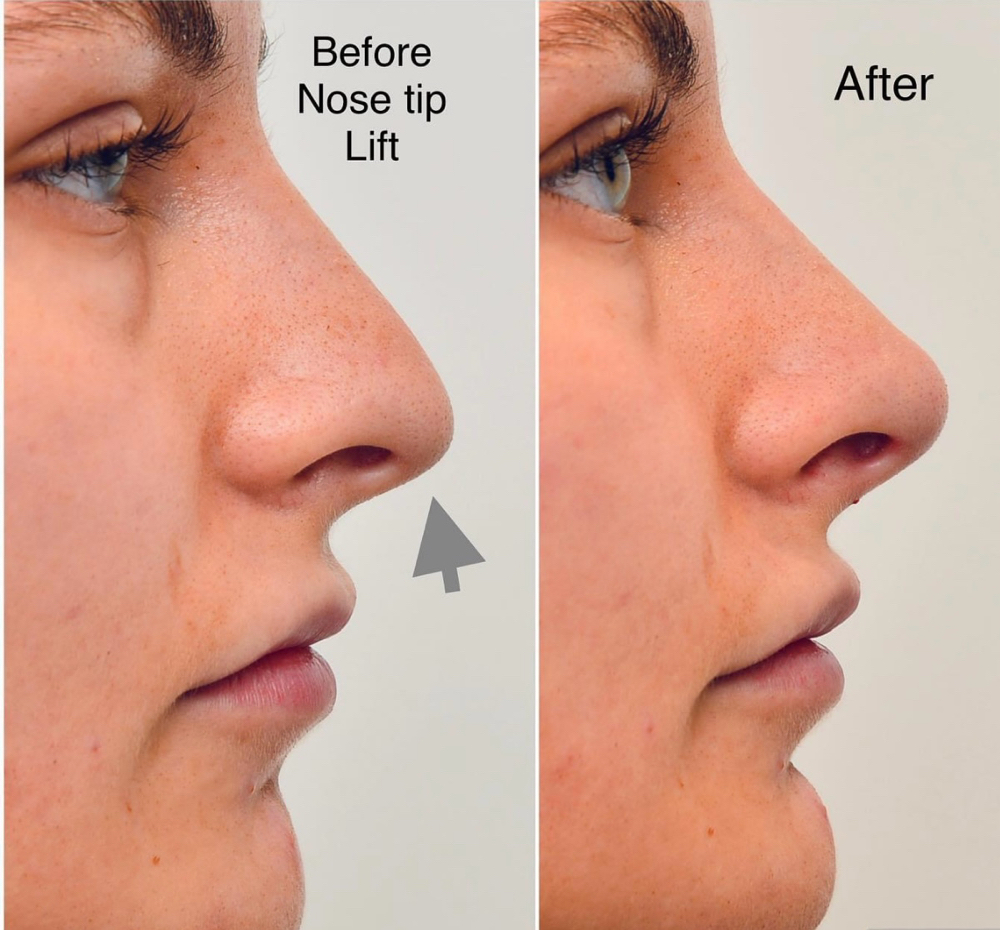 Botox Nose Lift