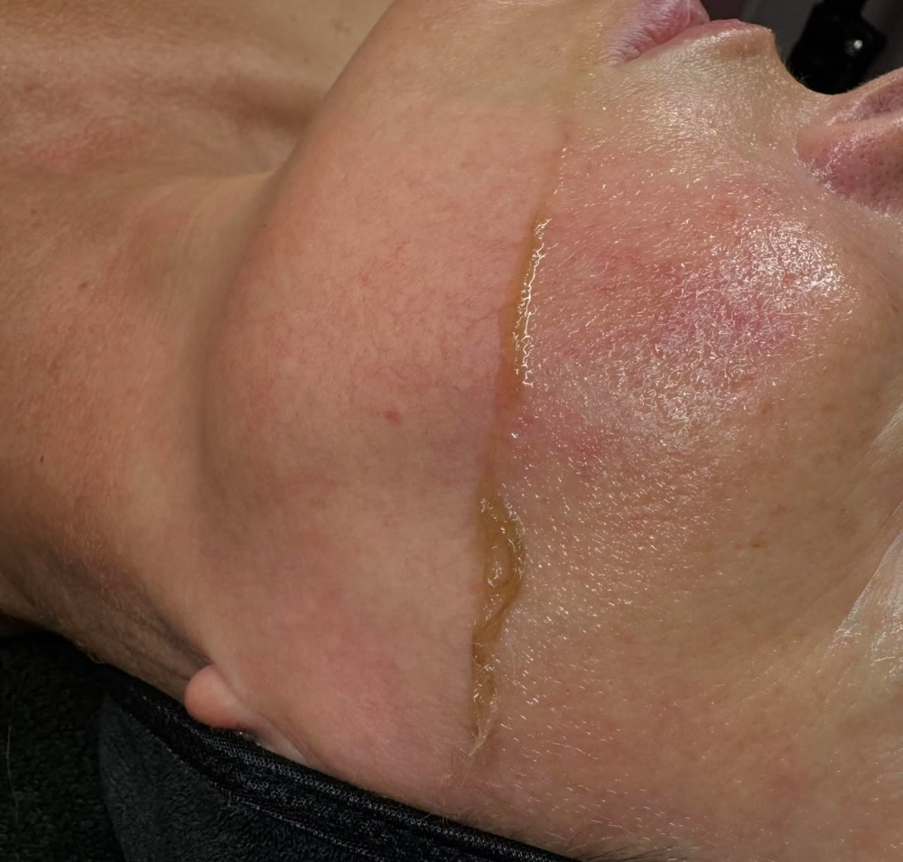 Dermaplane Facial