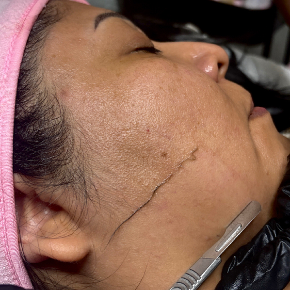 Dermaplane Facial at YasFleuraEsthetics in Springdale, AR