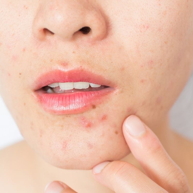 Acne Facial