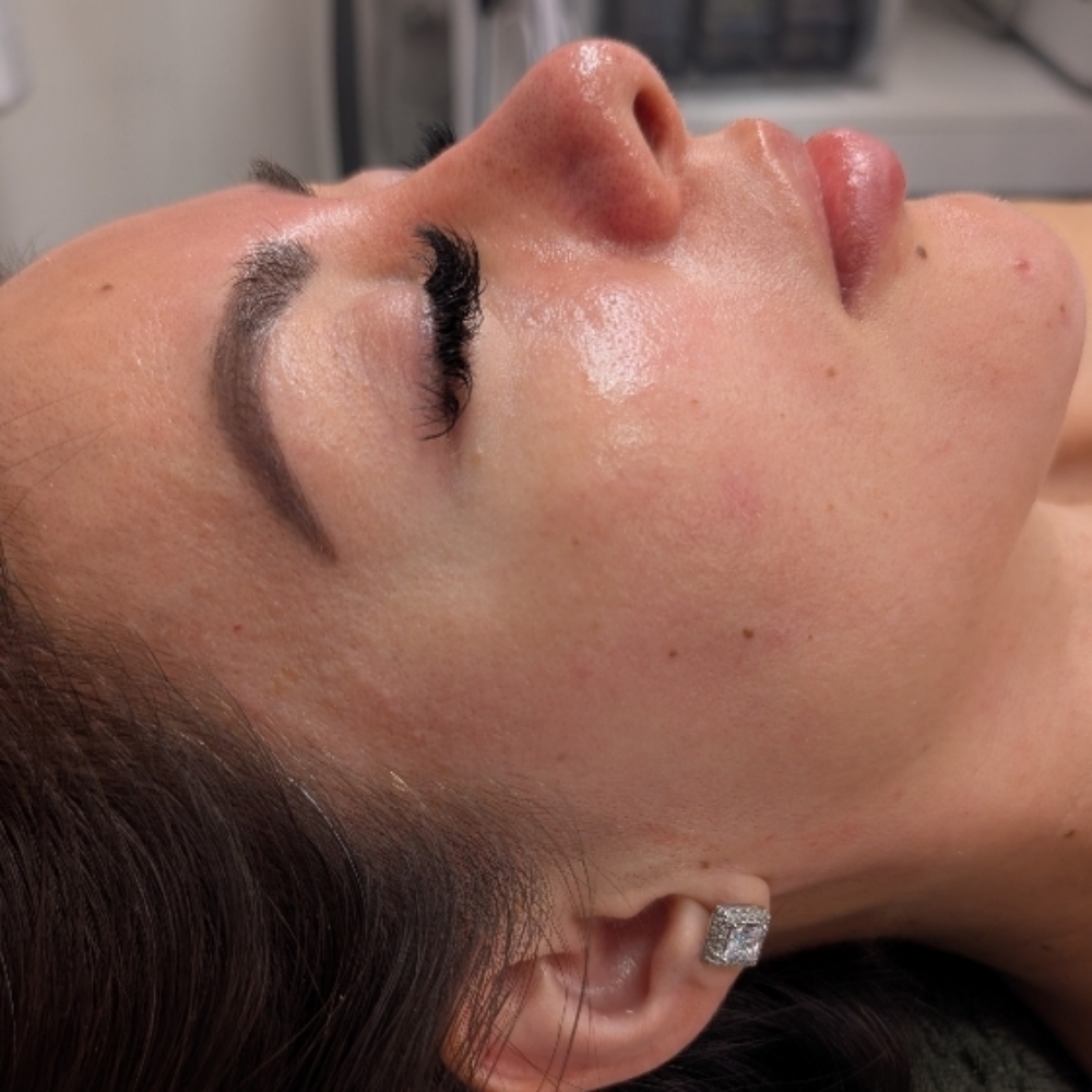 Co2 Carboxy Terapy at Nenusk Aesthetics in Long Island City, NY