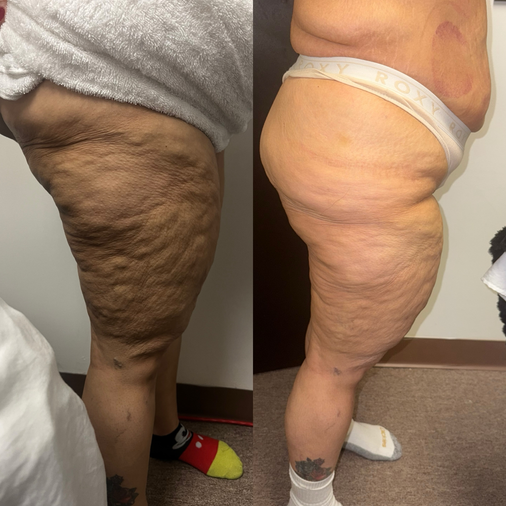 CELLULITE TREATMENT at Moon Massages By Beauty Glam Spa in Ansonia, CT
