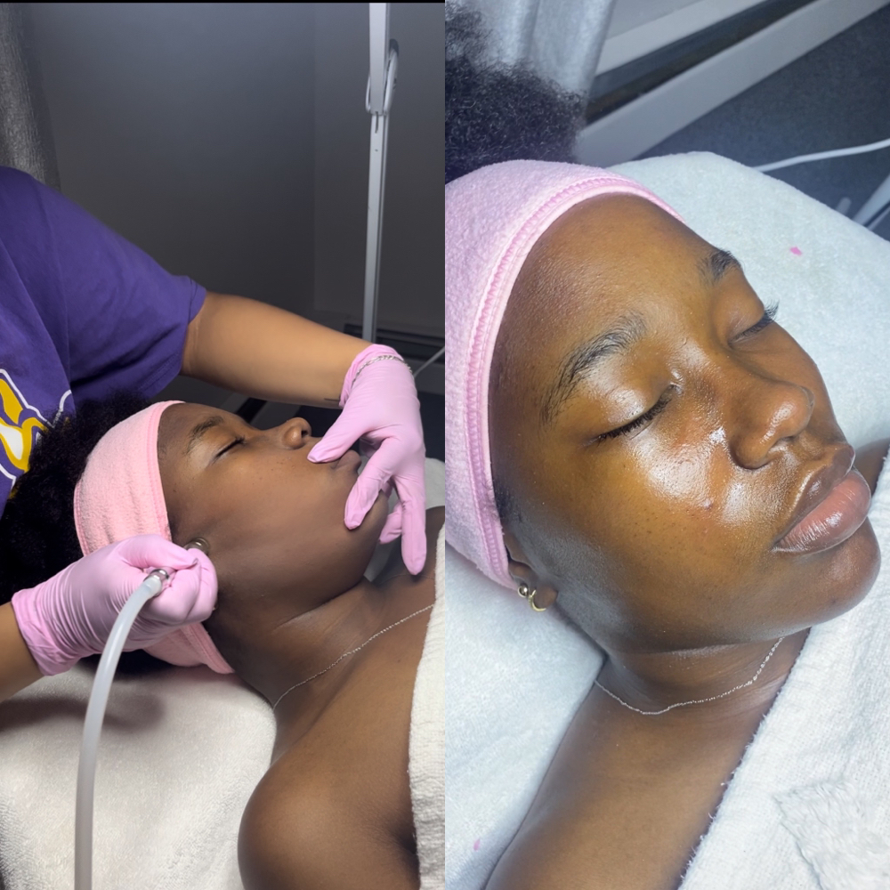 Microdermabrasion Facial