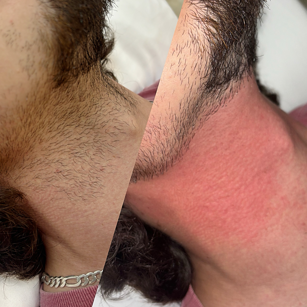 Neck Wax