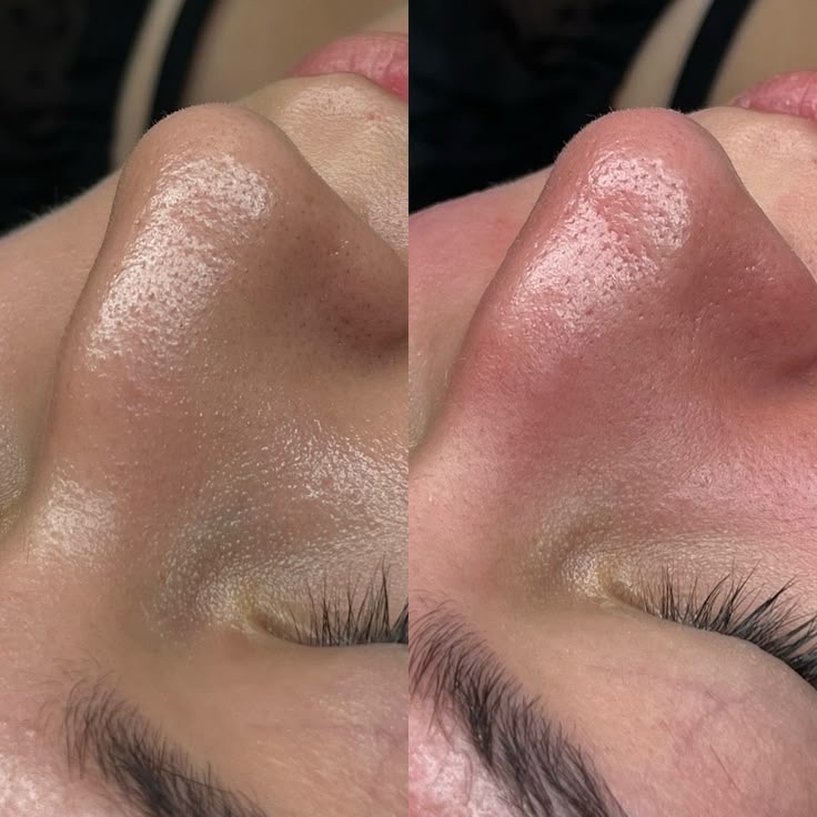 Hydrofacial