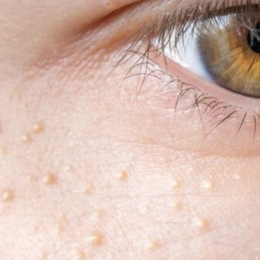 Milia Extractions at Magnetic Aesthetic LLC~ QC WELLNESS OFFICE in Queen Creek, AZ