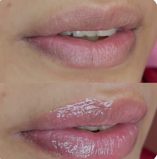 Hydra Lips