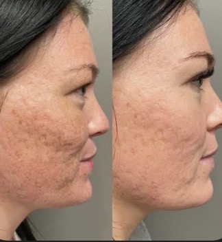 Micro needling + Radio Frequency