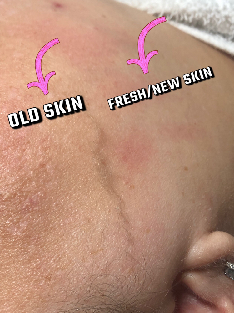 Dermaplane Facial
