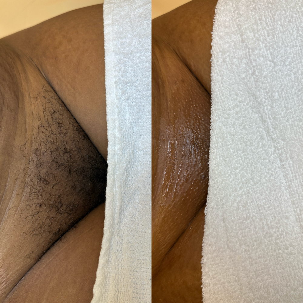 Full Brazillian Wax