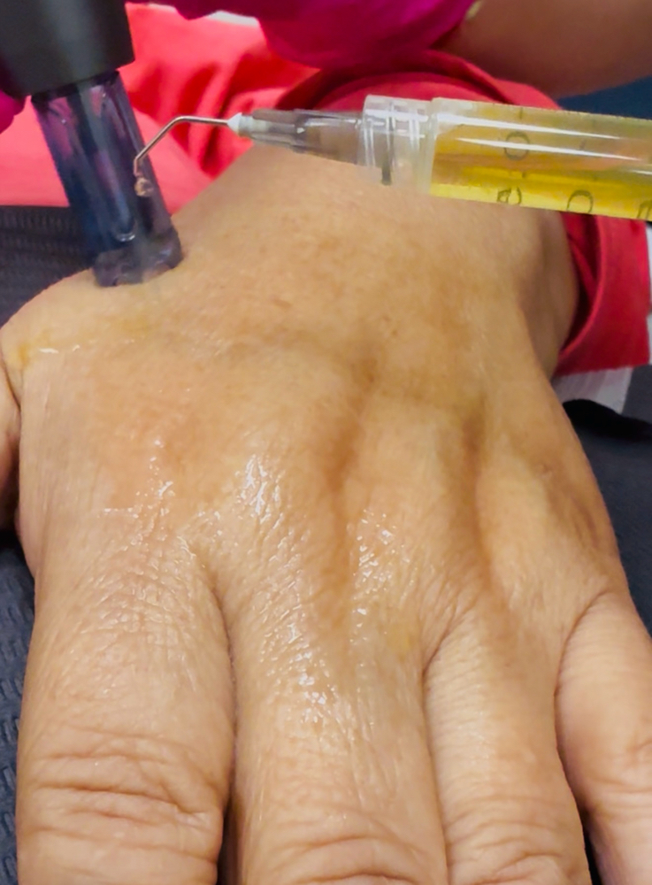 Hands PRP at Revital Med Aesthetics & Wellness in Oceanside, NY