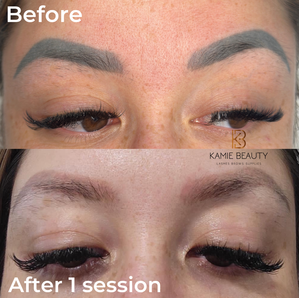 EYEBROWS REMOVAL LASER