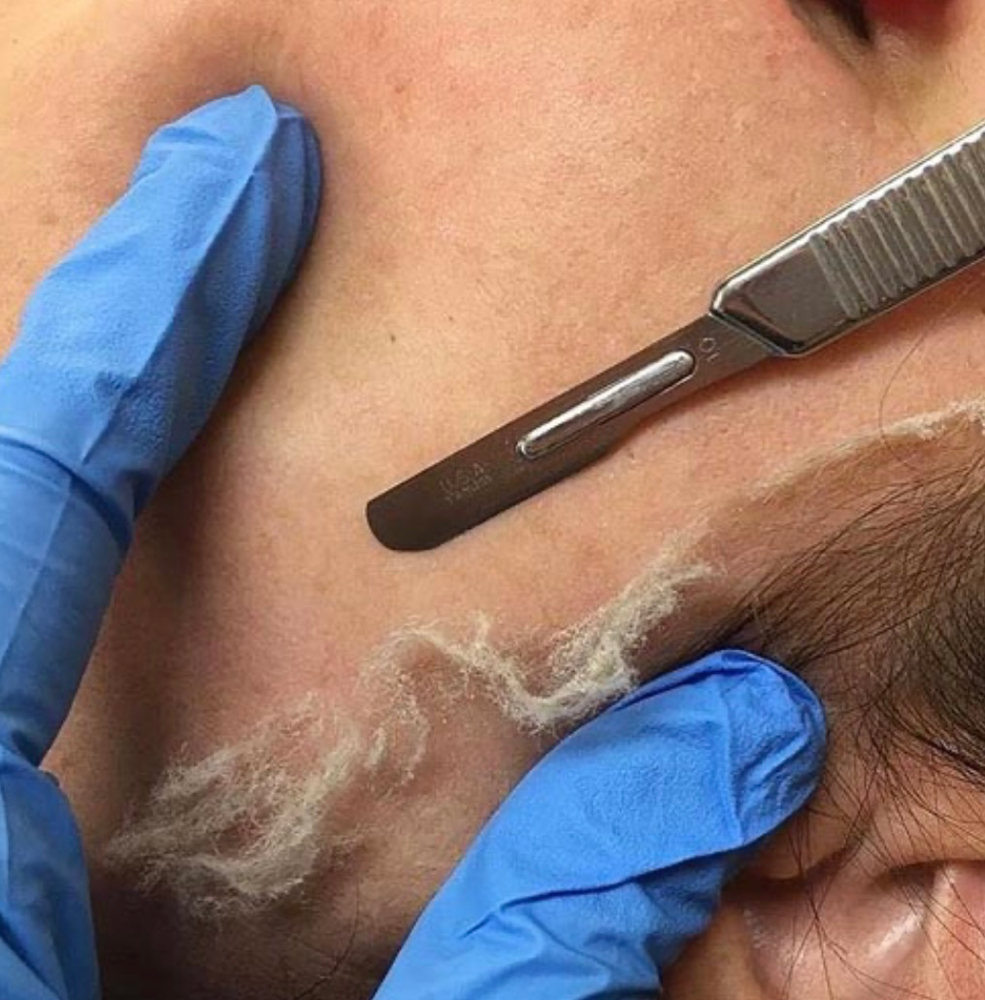 Dermaplaning Facial