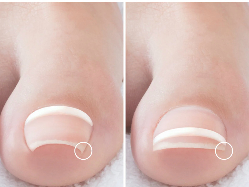 ONYFIX Nail Correction (per nail )