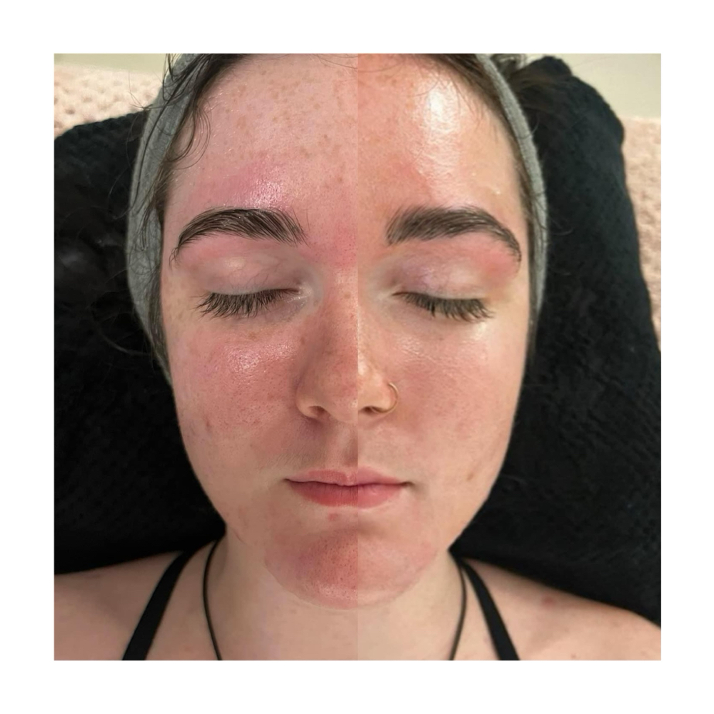Custom Facial