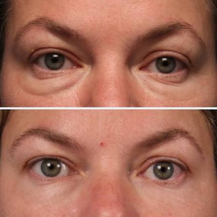 Morpheus8 eyes at Ultimate Health Spa in Leesburg, FL