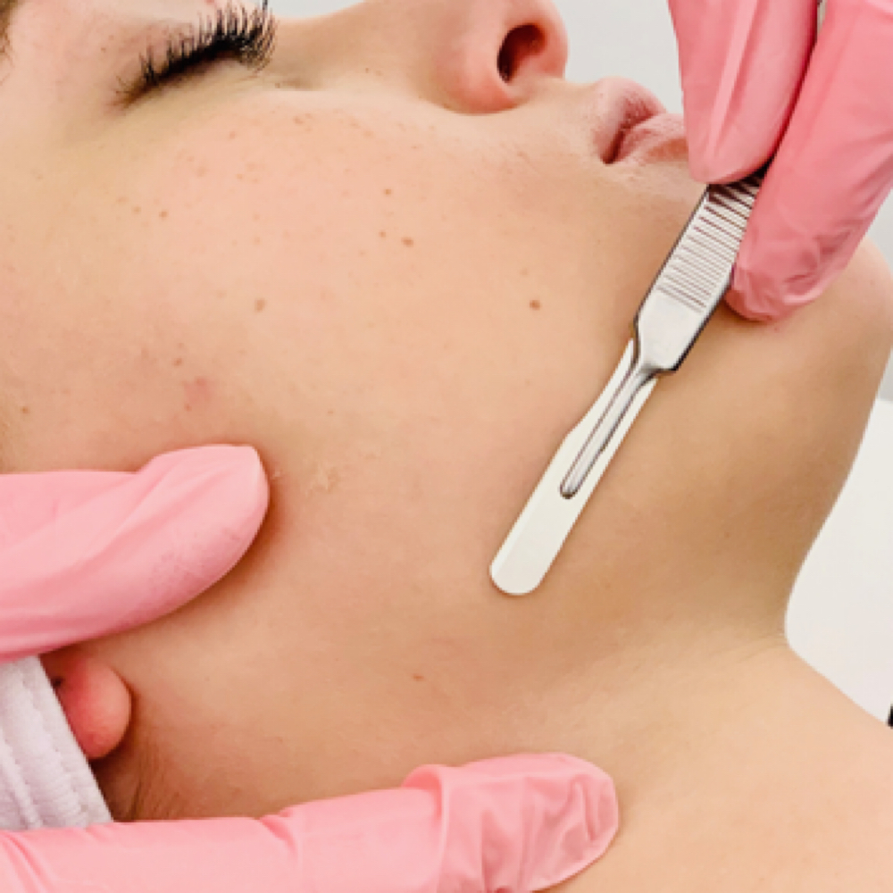 Dermaplane Add On at AK Aesthetics in Downers Grove, IL