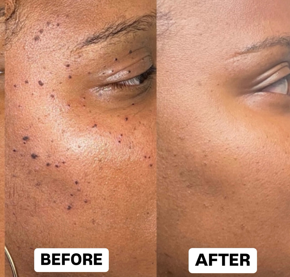DPN/ Skin Tag/ Mole Removal