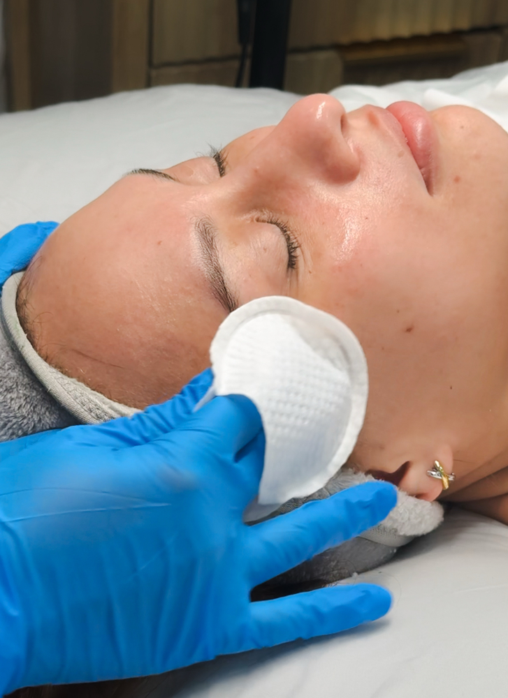 Chemical Peel at Eliana Esthetics in Mission, TX
