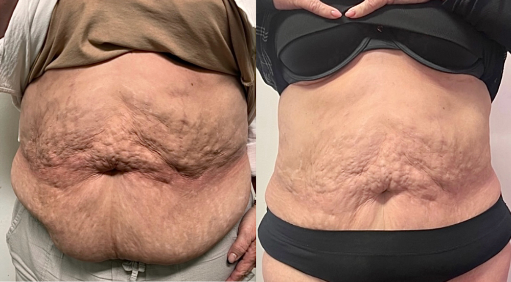 Fat Cavitation + RF (2 Areas)