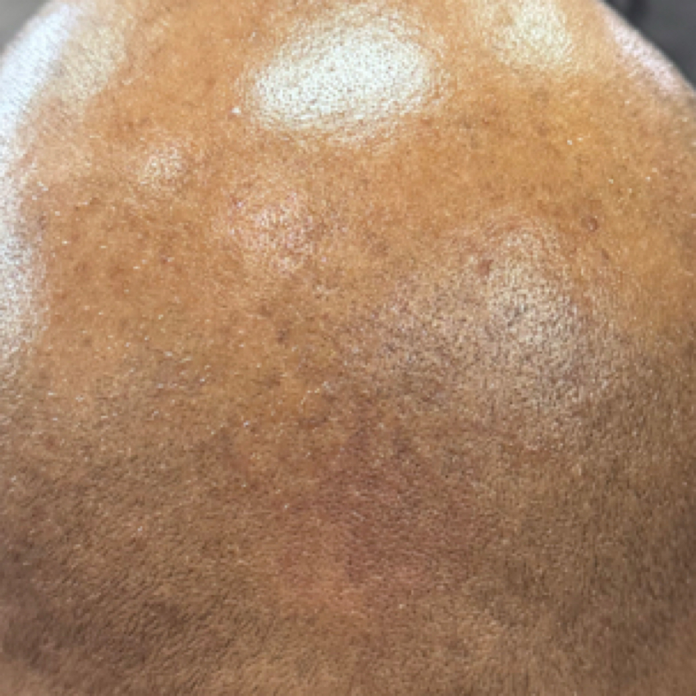 Scalp Microdermabrasion at Marsha Threatt in Jonesboro, GA