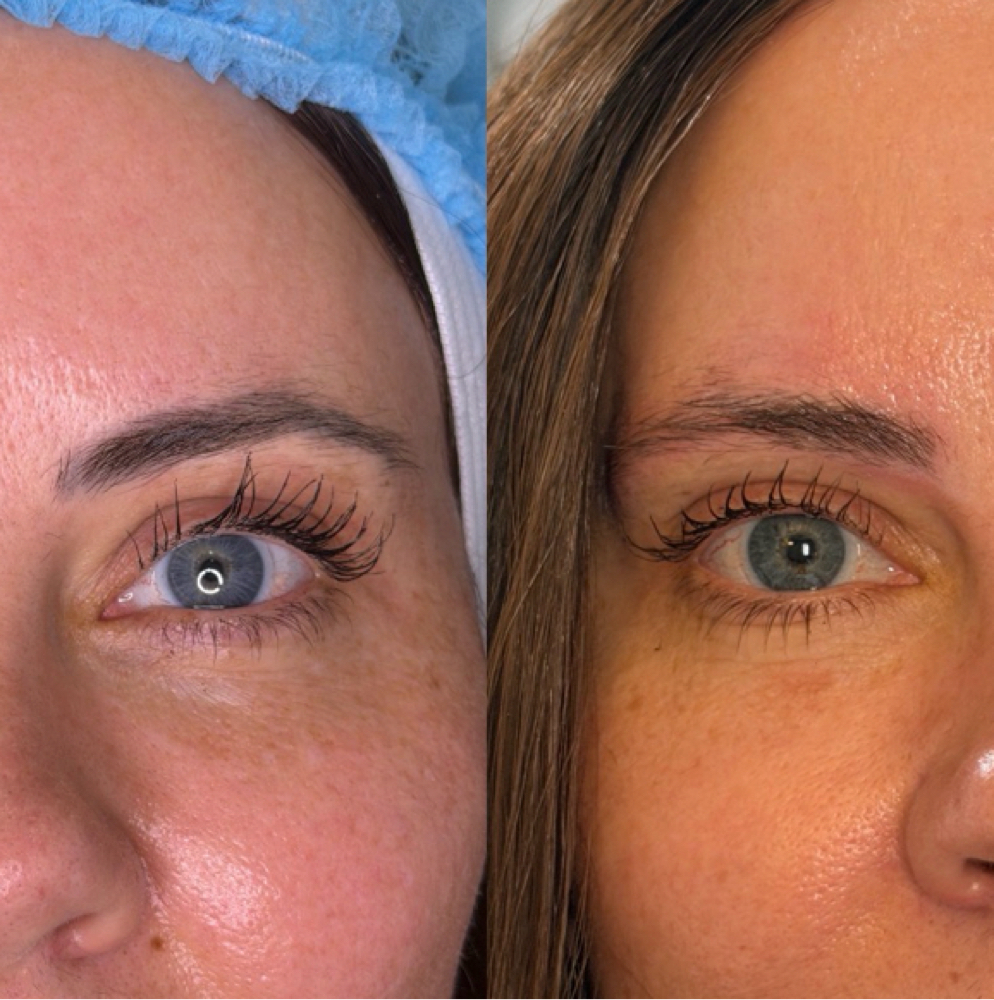Microblading (eyebrow) Removal at Corrective treatments + professional skincare in Atlanta, GA