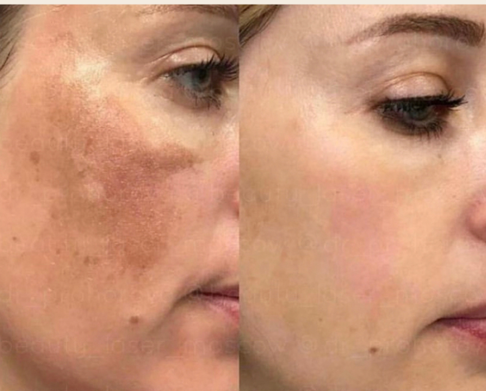 Bio-Exfoliant treatment