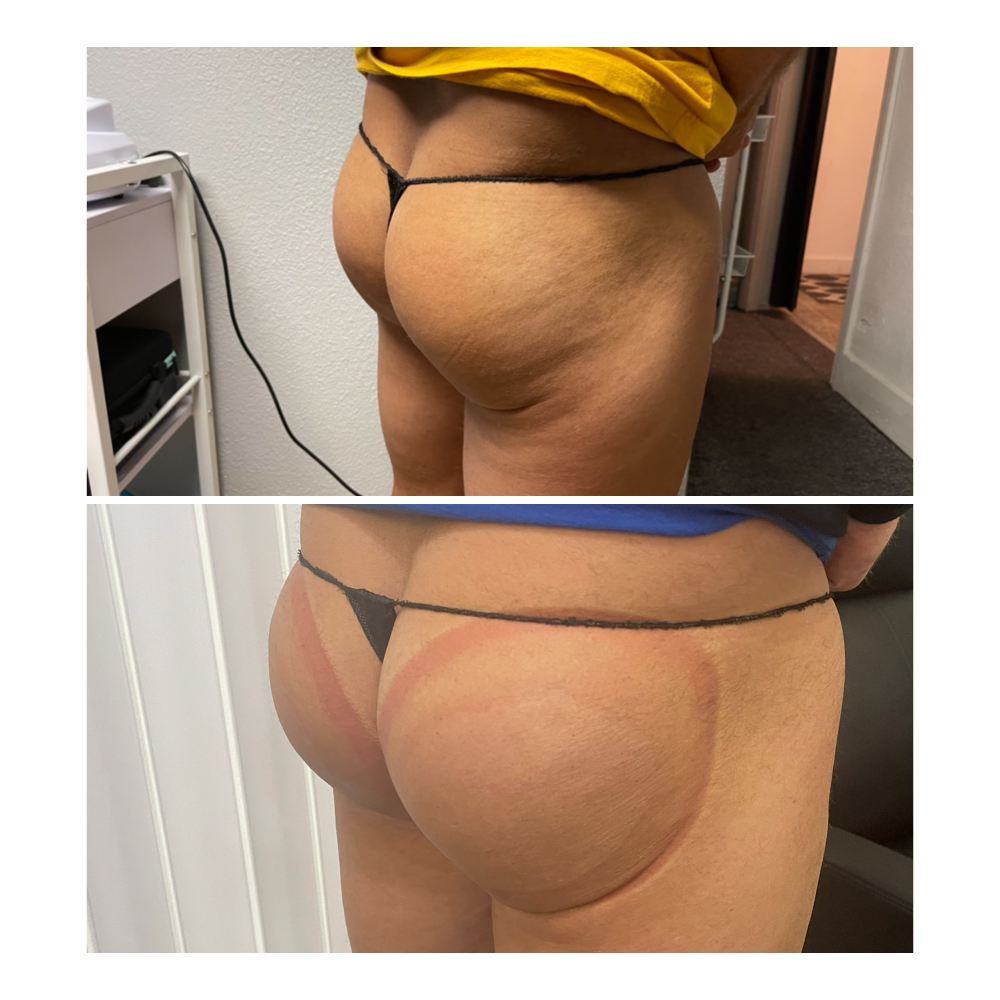 Brazillian Butt Lift