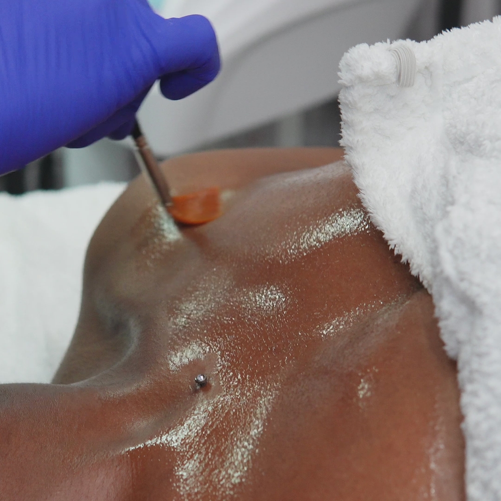VI Body Peel