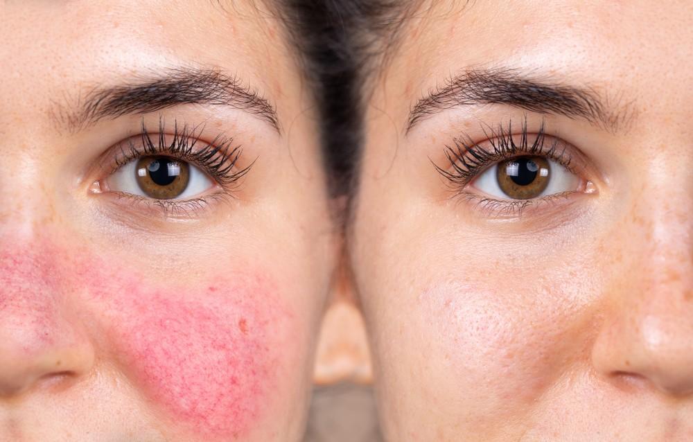 The Rosacea/Senstive Treatment