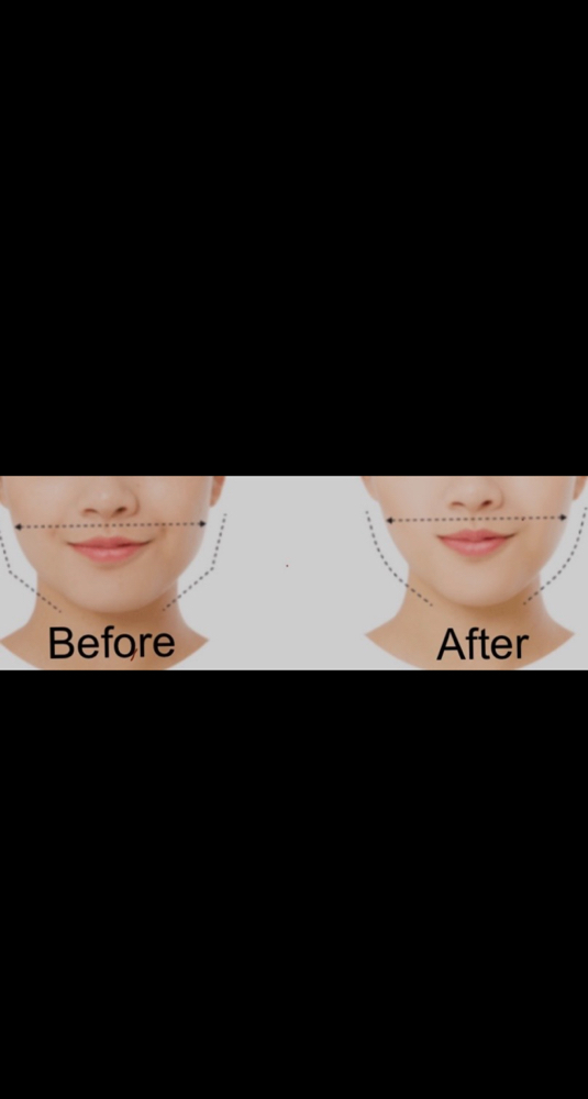 Masseter Botox