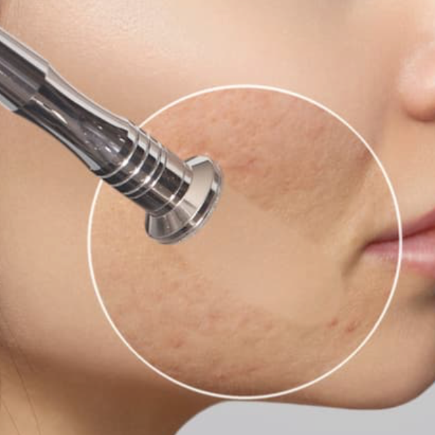 ✨ MICRODERMABRASION at JLo  Clinic in Cape Coral, FL