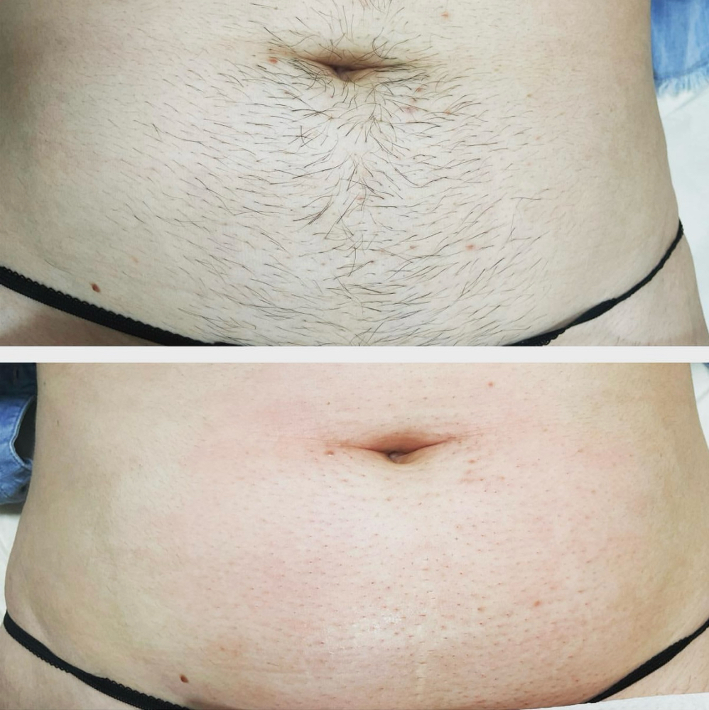 Lower Stomach Wax