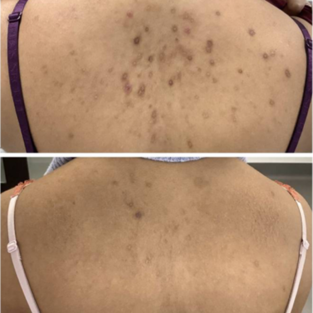 Full Back Treatment at Beauty And Body in San Dimas, CA