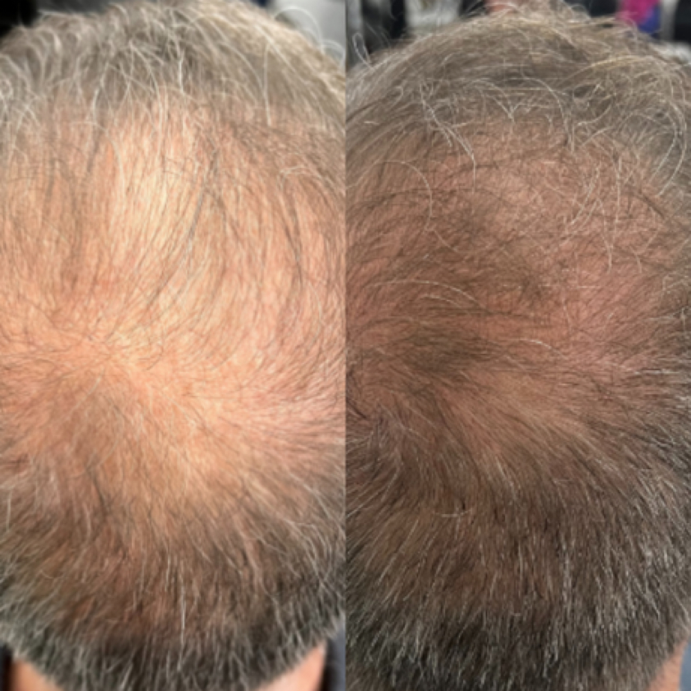 Scalp Microchanneling at Soul to Skin Esthetics in Bend, OR