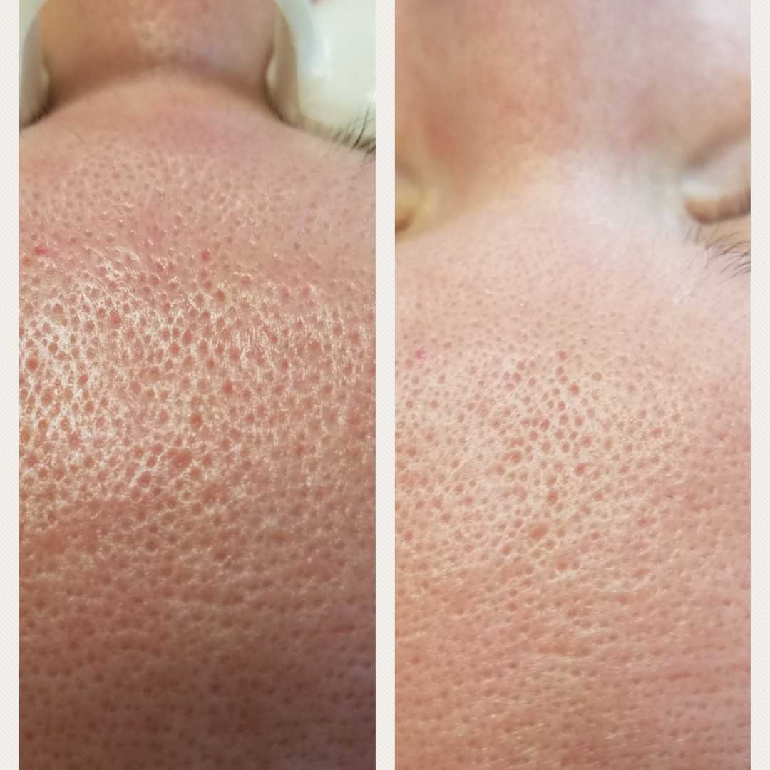 Microchanneling Trio at Freshly Plum Skincare in Sugar Hill, GA