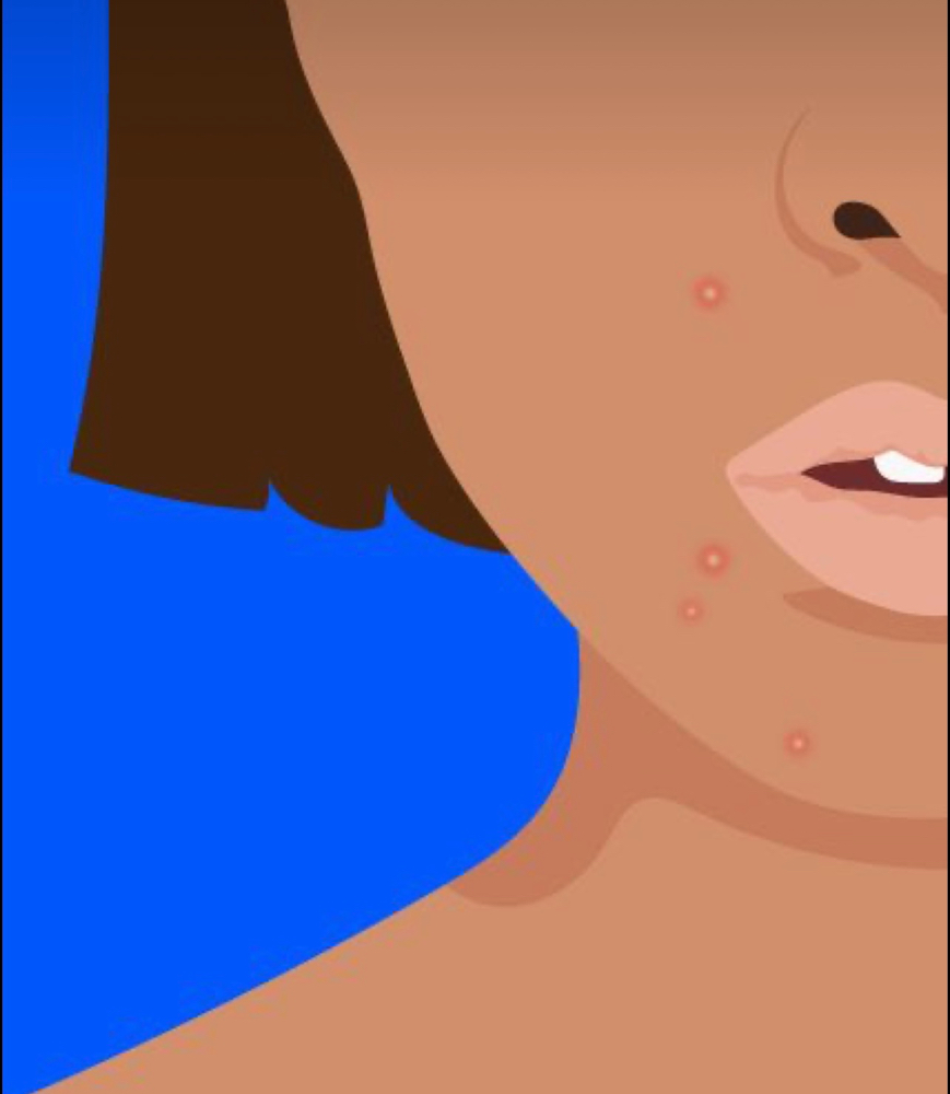 Chemical Queen Bee Acne Facial